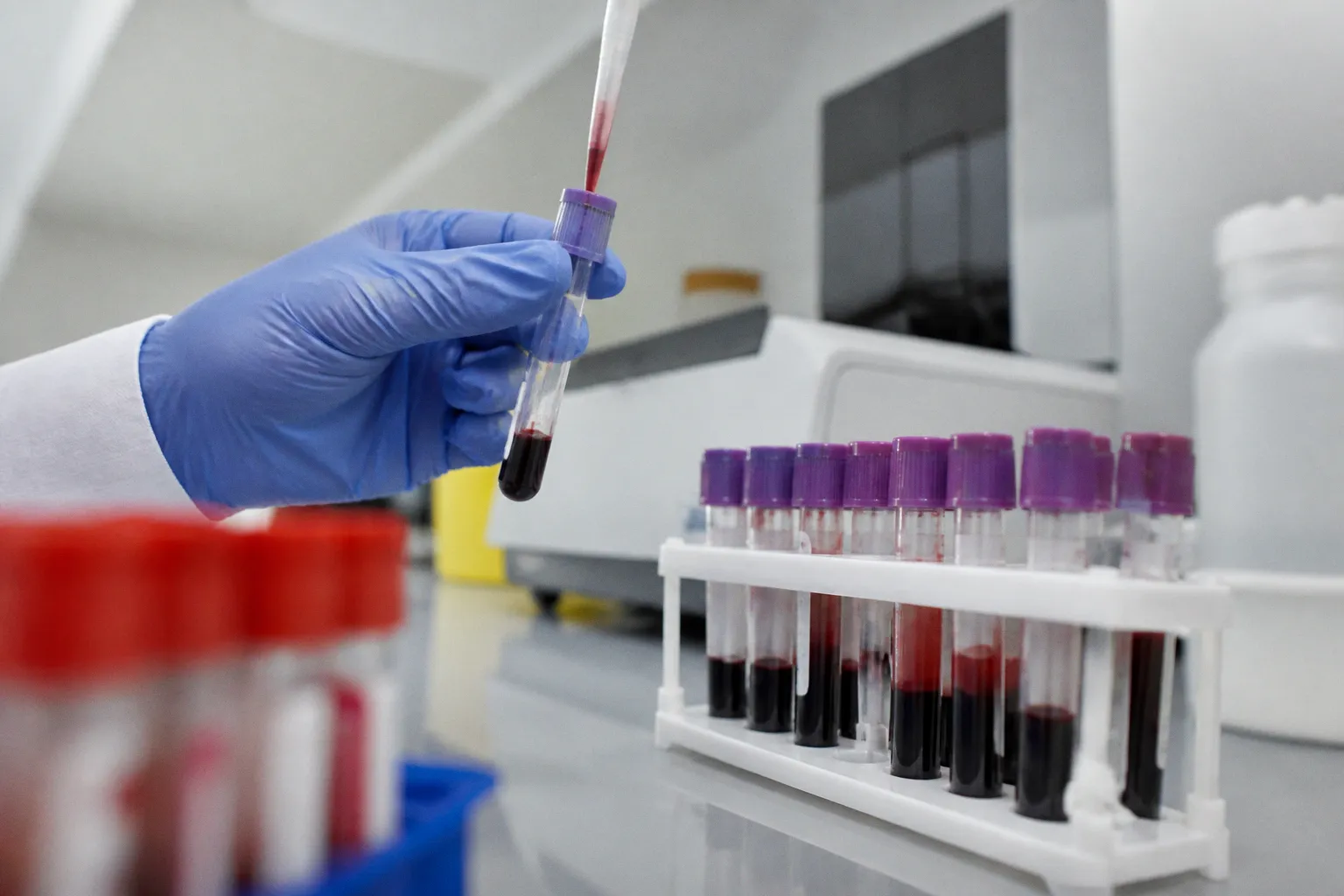 Cancer du sein : des biomarqueurs sanguins pour limiter le recours à la chimiothérapie