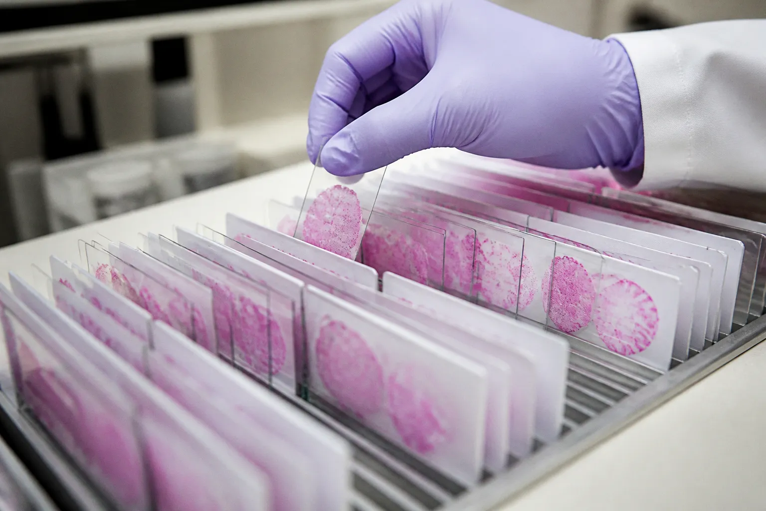 Intelligence artificielle et cancer du sein : vers des soins sur mesure